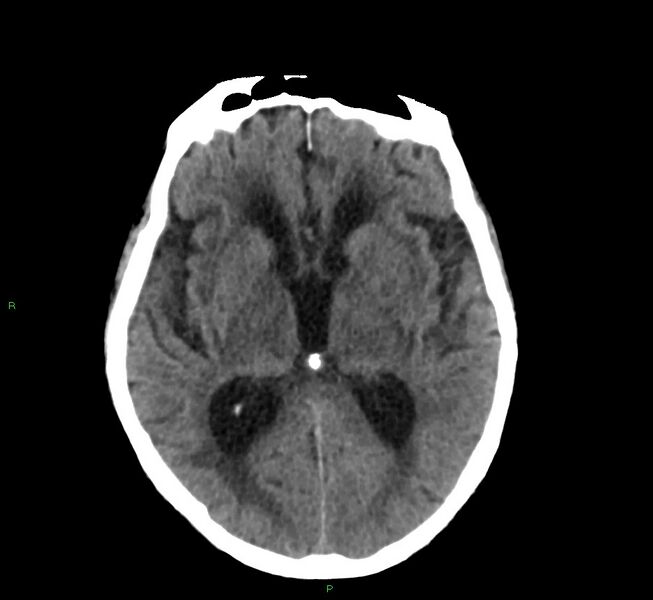 File:Cerebral amyloid angiopathy-associated lobar intracerebral hemorrhage (Radiopaedia 58530-65688 Axial non-contrast 26).jpg