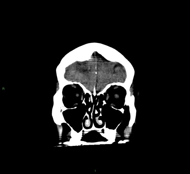 File:Cerebral amyloid angiopathy-associated lobar intracerebral hemorrhage (Radiopaedia 58560-65723 Coronal non-contrast 57).jpg