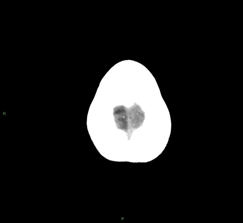 Cerebral amyloid angiopathy-associated lobar intracerebral hemorrhage (Radiopaedia 58754-65975 Axial non-contrast 12).jpg