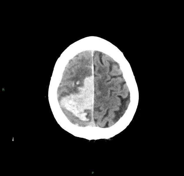 File:Cerebral amyloid angiopathy-associated lobar intracerebral hemorrhage (Radiopaedia 59356-66716 Axial non-contrast 9).jpg
