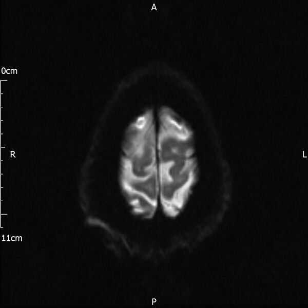 File:Cerebral amyloid angiopathy related inflammation (Radiopaedia 72772-83415 Axial DWI 22).jpg