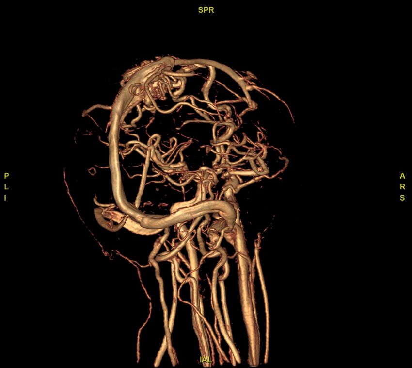 Cerebral arteriovenous malformation (Radiopaedia 61964-70029 VRT 21).jpg