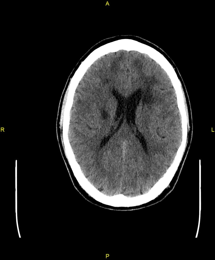 Cerebral autosomal dominant arteriopathy with subcortical infarcts and leukoencephalopathy (CADASIL) (Radiopaedia 86108-102051 Axial non-contrast 65).jpg