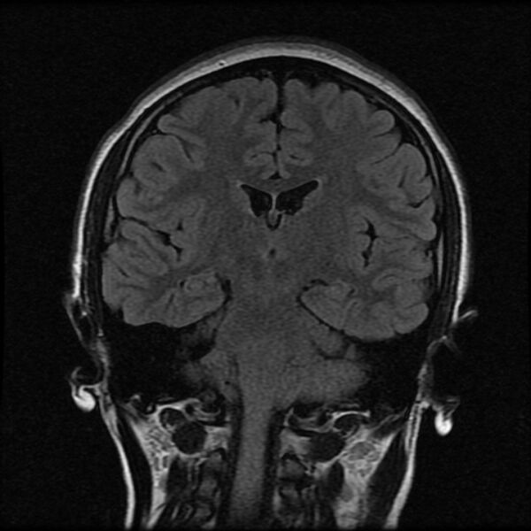 File:Cerebral cavernous malformation (Radiopaedia 44301-47942 Coronal FLAIR 12).jpg