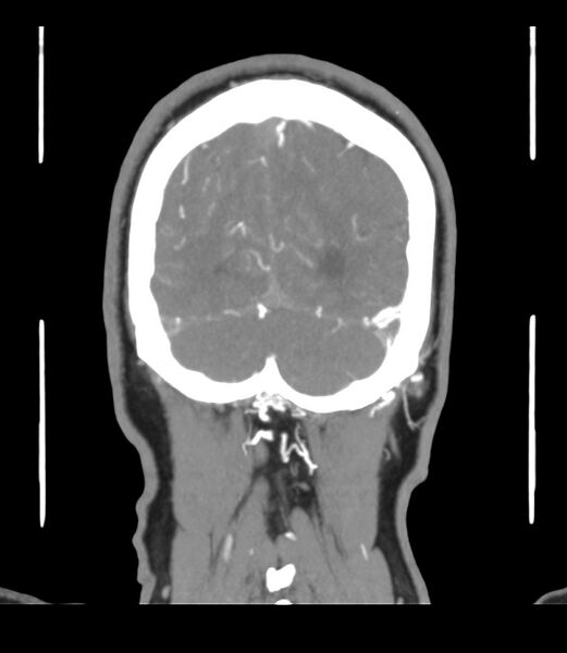 File:Cerebral dural venous sinus thrombosis (Radiopaedia 86514-102576 B 65).jpg