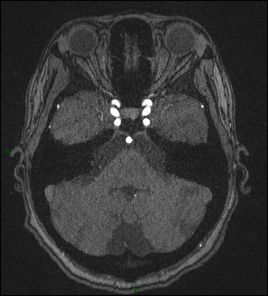 File:Cerebral fat embolism (Radiopaedia 35022-36525 Axial TOF 48).jpg