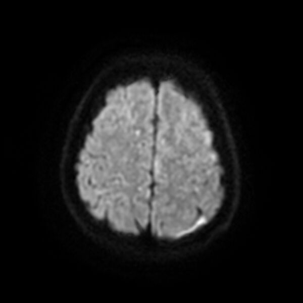 File:Cerebral fat embolism (Radiopaedia 37510-39363 Axial DWI 21).jpg