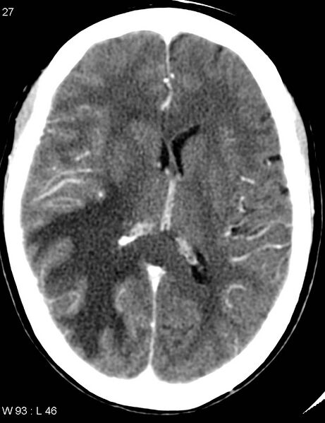 File:Cerebral metastasis - lung cancer (Radiopaedia 5315-7072 Axial C+ delayed 3).jpg