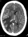 Cerebral metastasis - lung cancer (Radiopaedia 5315-7072 Axial C+ delayed 3).jpg