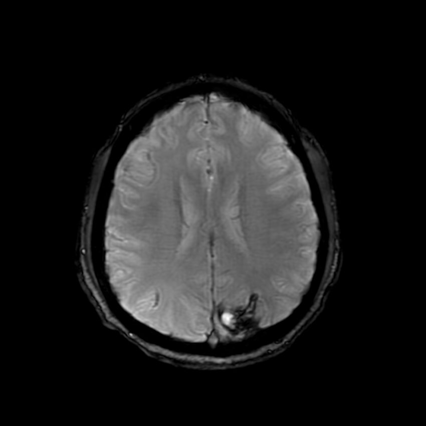 Cerebral paragonimiasis (Radiopaedia 73473-84238 Axial SWI 45).jpg