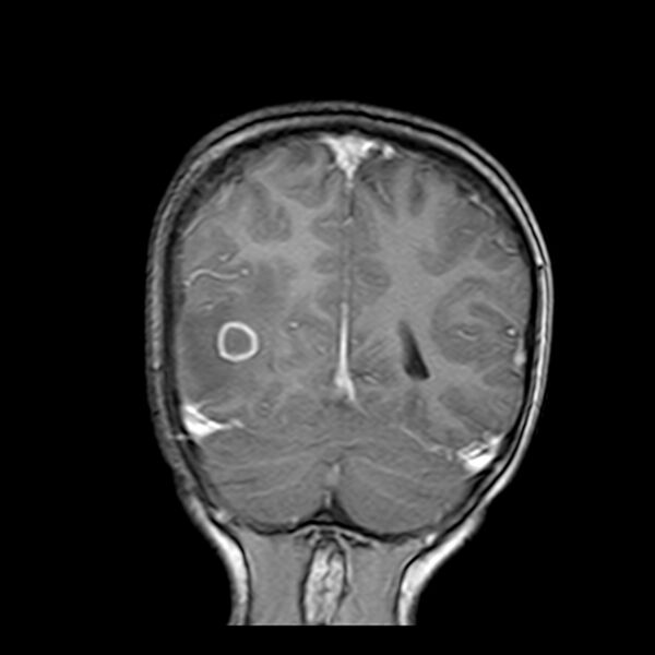 File:Cerebral tuberculoma (Radiopaedia 41152-43932 Coronal T1 C+ 17).jpg
