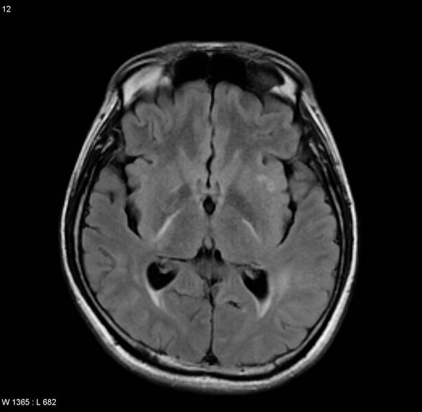 File:Cerebral vasculitis (Radiopaedia 5131-6923 Axial FLAIR 5).jpg