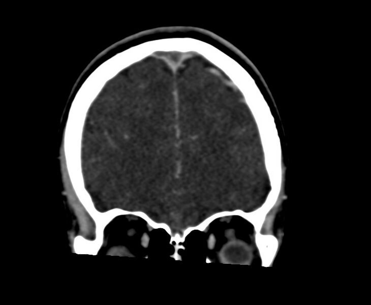 File:Cerebral venous sinus thrombosis (Radiopaedia 59224-66646 Coronal C+ delayed 15).jpg