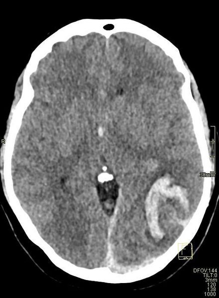 File:Cerebral venous sinus thrombosis (Radiopaedia 91329-108965 Axial non-contrast 24).jpg