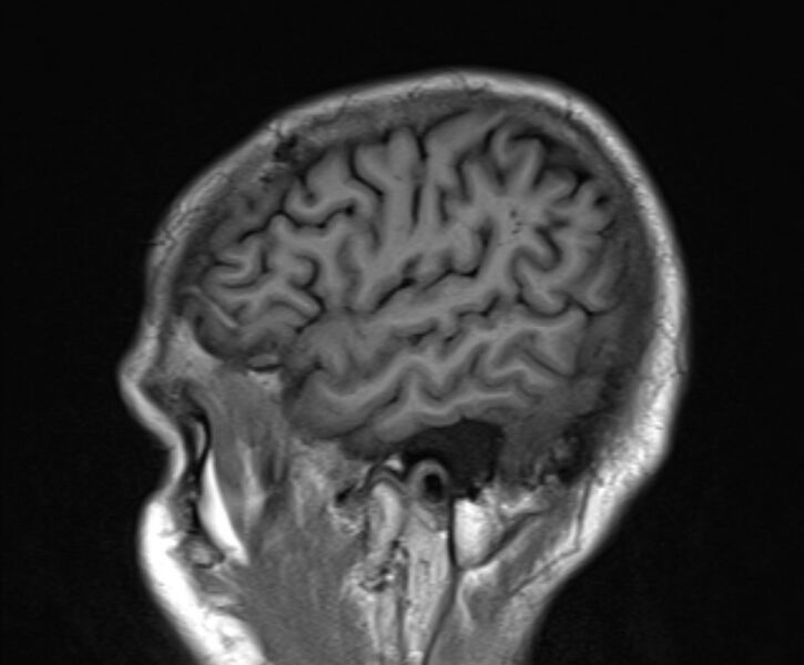 File:Cerebral venous thrombosis (Radiopaedia 71207-81504 Sagittal T1 22).jpg