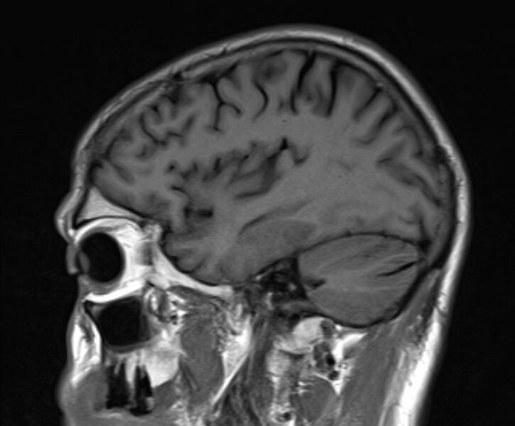 File:Cerebral venous thrombosis (Radiopaedia 71207-81504 Sagittal T1 7).jpg