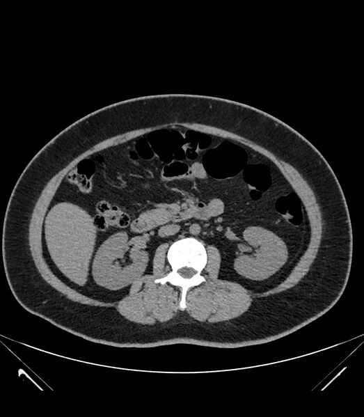 File:Cervical aortic arch with coarctation and aneurysms (Radiopaedia 44035-47552 Axial non-contrast 58).jpg