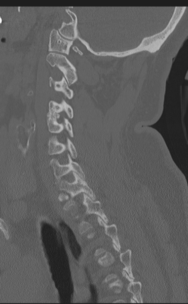 File:Cervical canal stenosis due to ossification of the posterior longitudinal ligament (Radiopaedia 47260-51823 Sagittal bone window 49).png