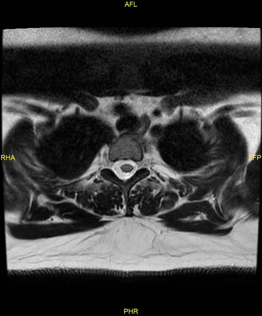 Cervical disc protrusion (Radiopaedia 87147-103415 Axial T2 94).jpg