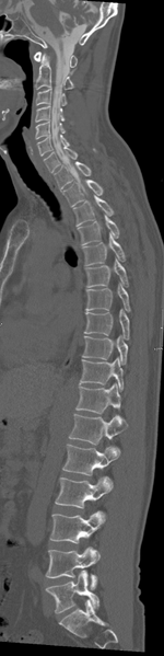 File:Cervical dural CSF leak on MRI and CT treated by blood patch (Radiopaedia 49748-54996 A 4).png