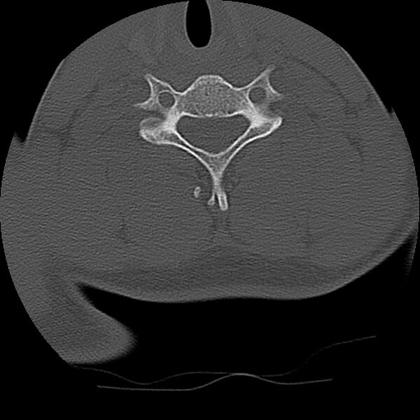 File:Cervical flexion teardrop fracture with cord hemorrhage (Radiopaedia 32497-33454 Axial bone window 59).jpg