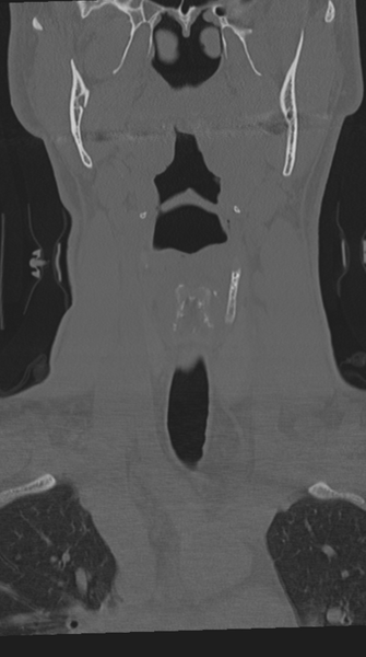 File:Cervical intercalary bone (Radiopaedia 35211-36748 Coronal bone window 17).png