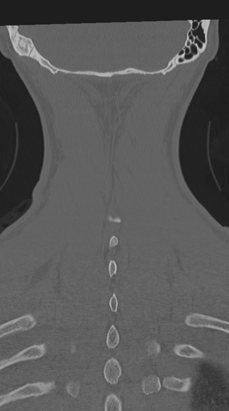 File:Cervical intercalary bone (Radiopaedia 35211-36748 Coronal bone window 66).png
