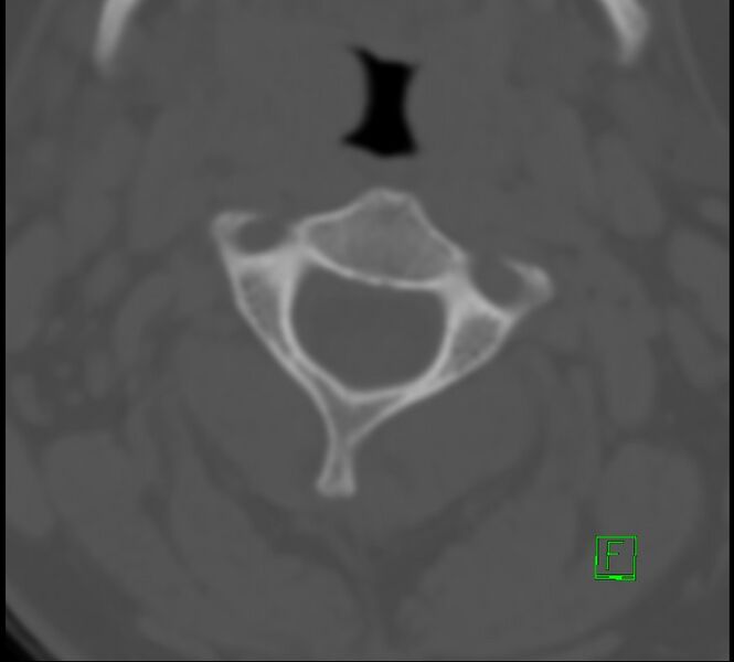 File:Cervical spine fracture - hyperflexion injury (Radiopaedia 66184-75364 Axial bone window 8).jpg