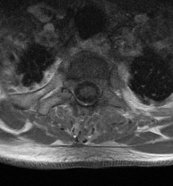 File:Cervical spondylodiscitis (Radiopaedia 81362-95110 Axial T1 C+ fat sat 20).jpg