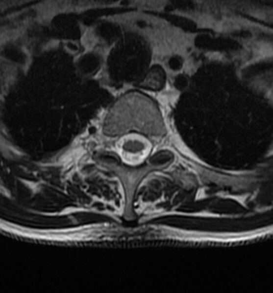 File:Cervical spondylodiscitis (Radiopaedia 81362-95110 Axial T2 24).jpg
