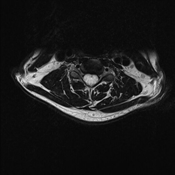 File:Cervical tumor-like myelopathy due to Type V dAVF (Radiopaedia 82461-96604 Axial T2 19).jpg