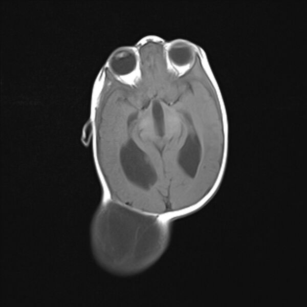 File:Chiari III malformation with occipital encephalocele (Radiopaedia 79446-92559 Axial T1 14).jpg