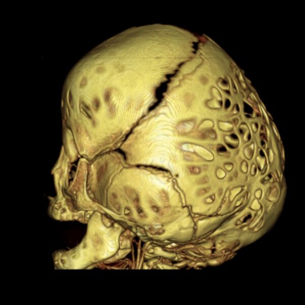 File:Chiari I and severe copper beaten skull (Radiopaedia 5993-7504 3D reconstruction 1).jpg