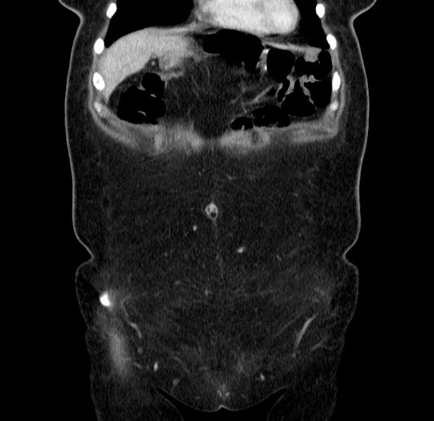 File:Choledocholithiasis on CT and MRI (Radiopaedia 24825-25087 C 10).jpg