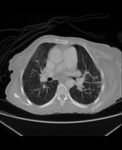 File:Chondrosarcoma (Radiopaedia 79427-92535 Axial lung window 25).jpg