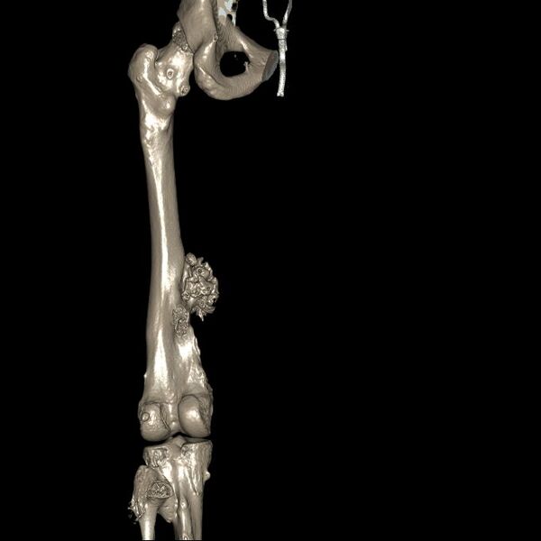 File:Chondrosarcoma arising from exostosis (Radiopaedia 59996-67507 3D Reconstruction 6).jpg