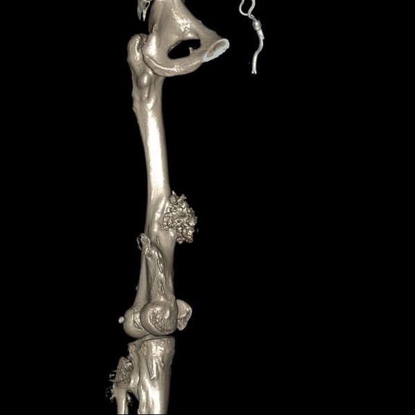 File:Chondrosarcoma arising from exostosis (Radiopaedia 59996-67507 3D Reconstruction 7).jpg