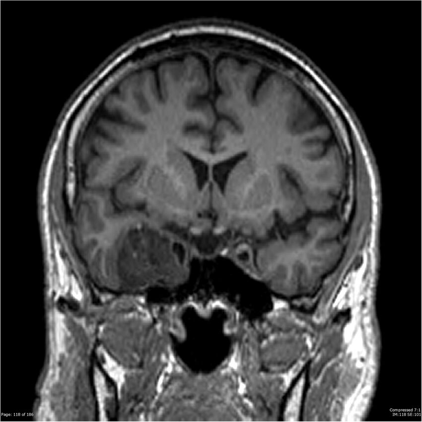 Chondrosarcoma of skull base- grade II (Radiopaedia 40948-43654 Coronal T1 39).jpg