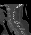 Chordoma (C4 vertebra) (Radiopaedia 47561-52188 Sagittal bone window 41).png