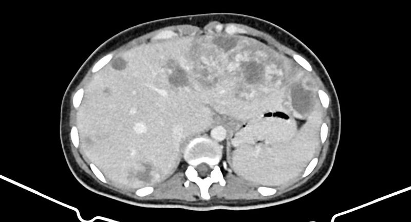 File:Choriocarcinoma liver metastases (Radiopaedia 74768-85766 A 47).jpg