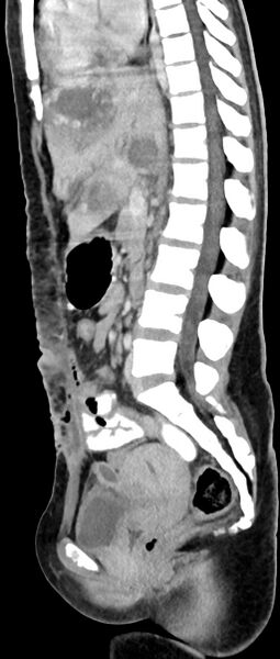 File:Choriocarcinoma liver metastases (Radiopaedia 74768-85766 C 97).jpg