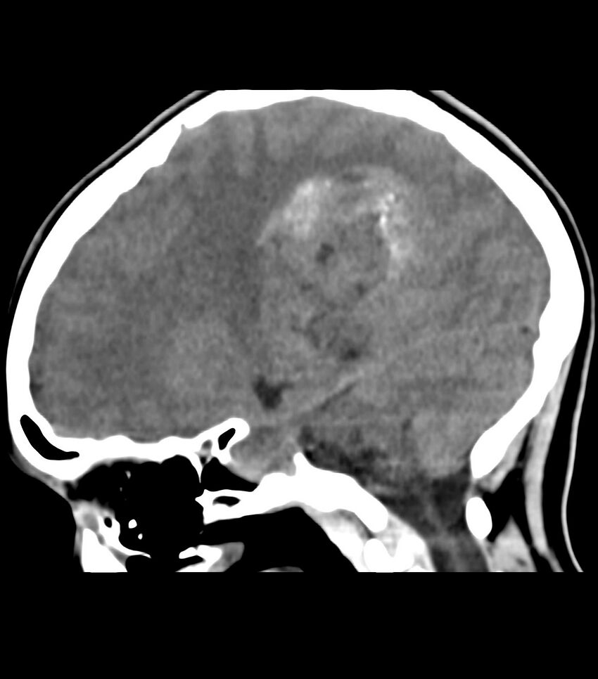 Choroid plexus carcinoma (Radiopaedia 91013-108552 B 43).jpg