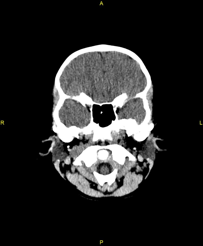 Choroidal fissure cyst (Radiopaedia 89481-106465 Axial non-contrast 25).jpg