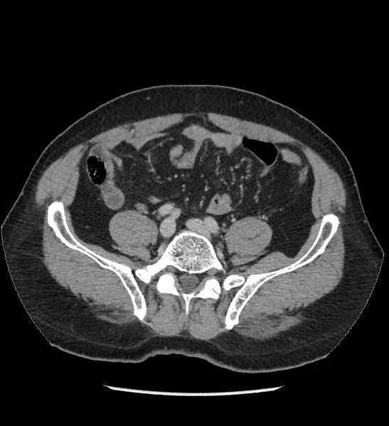 File:Chromophobe renal cell carcinoma (Radiopaedia 86879-103083 C 105).jpg