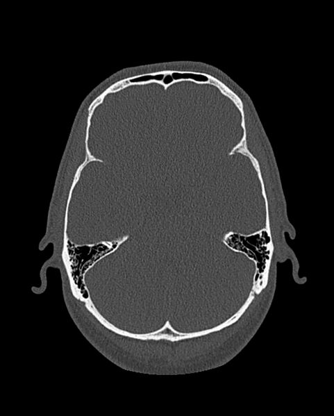 File:Chronic maxillary sinusitis caused by a foreign body (Radiopaedia 58521-65676 Axial bone window 288).jpg