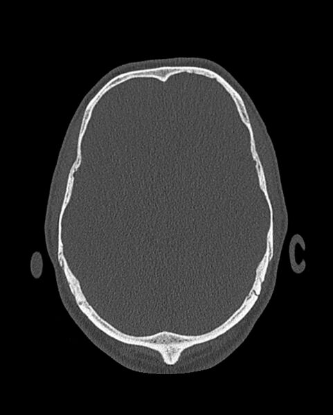 File:Chronic maxillary sinusitis caused by a foreign body (Radiopaedia 58521-65676 Axial bone window 334).jpg