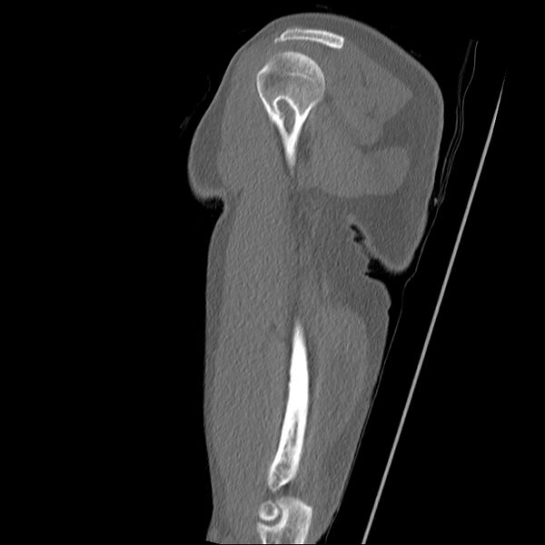 File:Chronic osteomyelitis (Radiopaedia 67597-76998 Sagittal bone window 10).jpg