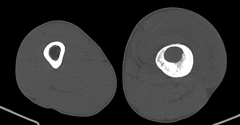 File:Chronic osteomyelitis (with sequestrum) (Radiopaedia 74813-85822 Axial non-contrast 111).jpg