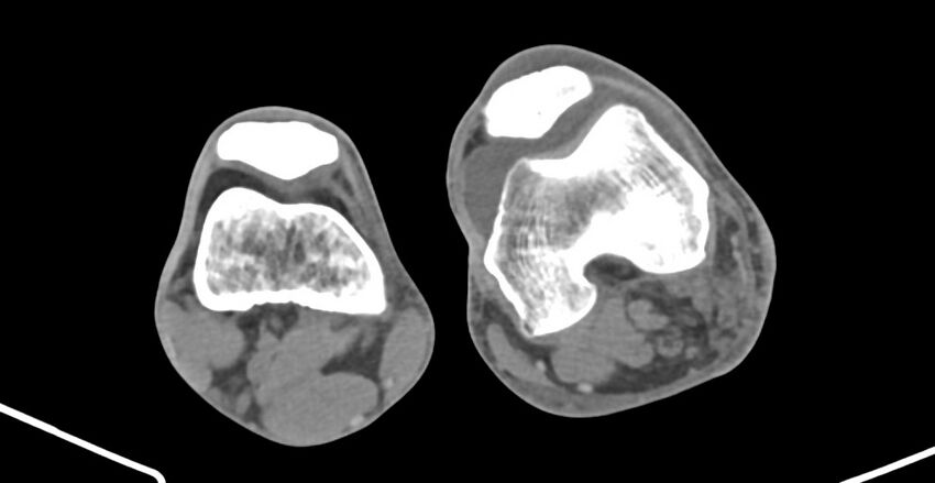 Chronic osteomyelitis (with sequestrum) (Radiopaedia 74813-85822 D 181).jpg