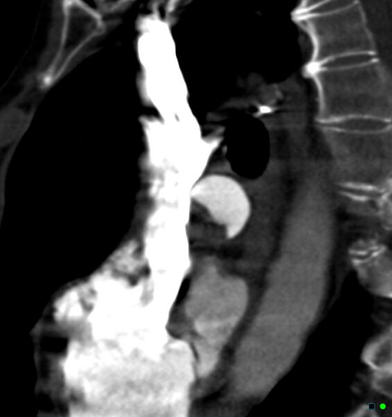 File:Chronic pulmonary embolism (Radiopaedia 17943-17702 Sagittal C+ CTPA 14).jpg